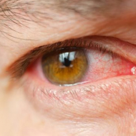Göz tansiyonu hastalığı“Glokom” nedir?    