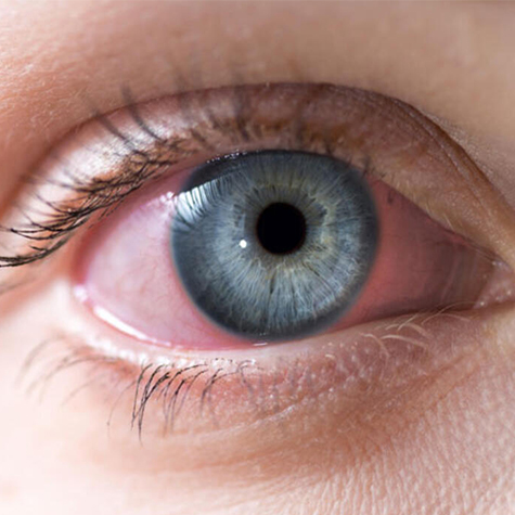 ''Konjonktivit'' Göz kızarıklığı virüs belirtisi olabilir